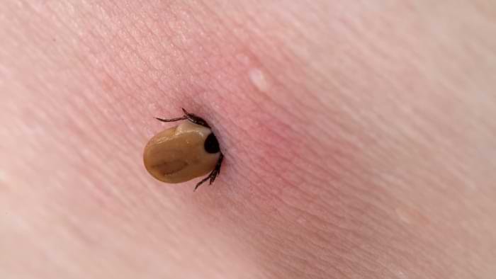 piqure tique démangeaison rougeur humain homme